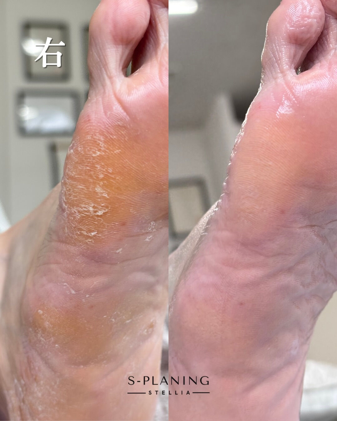 韓国式足裏角質ケア　Stellia　です